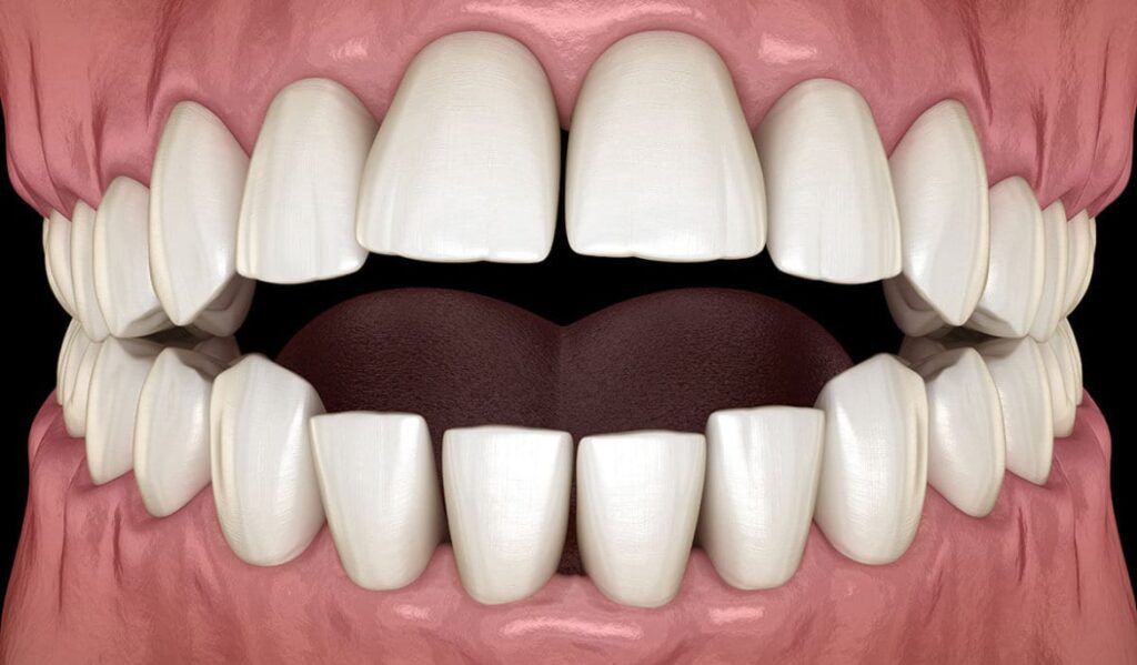 Malocclusion