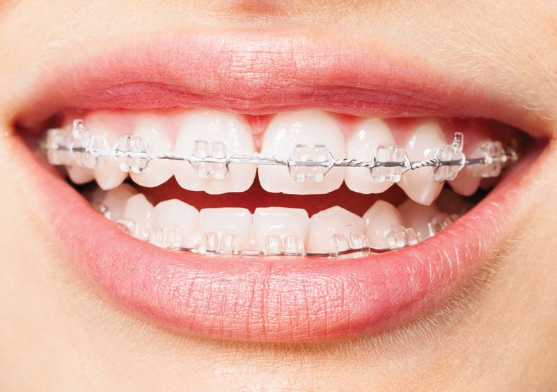 Ceramic Braces