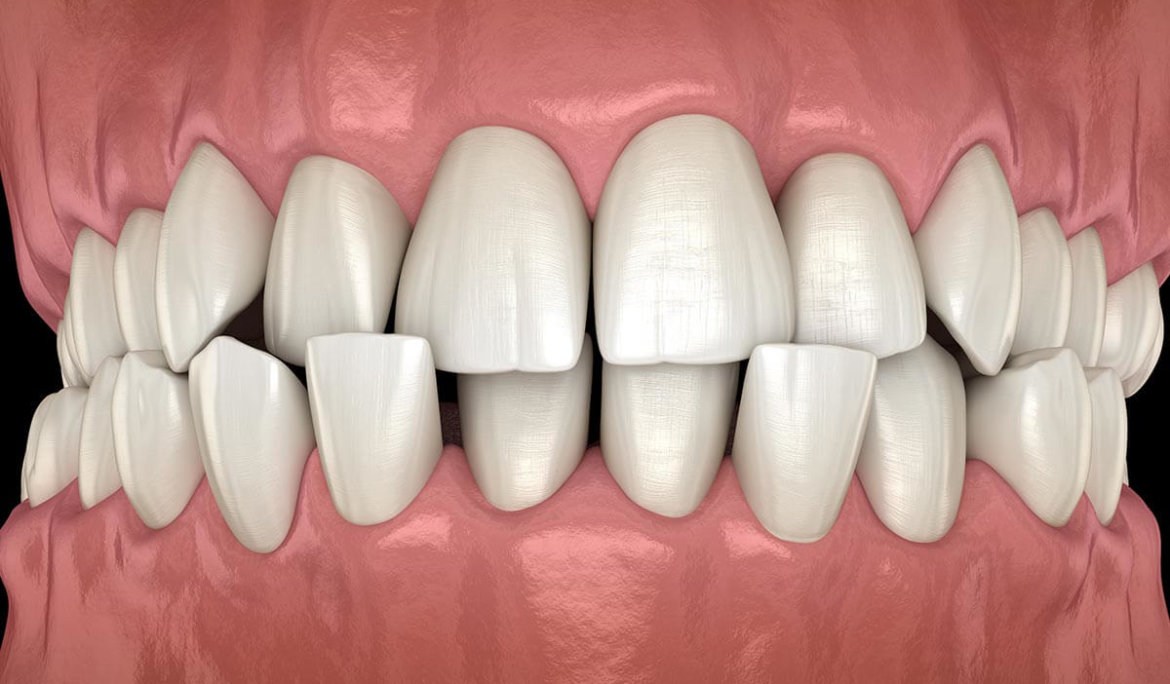 Crowded Teeth