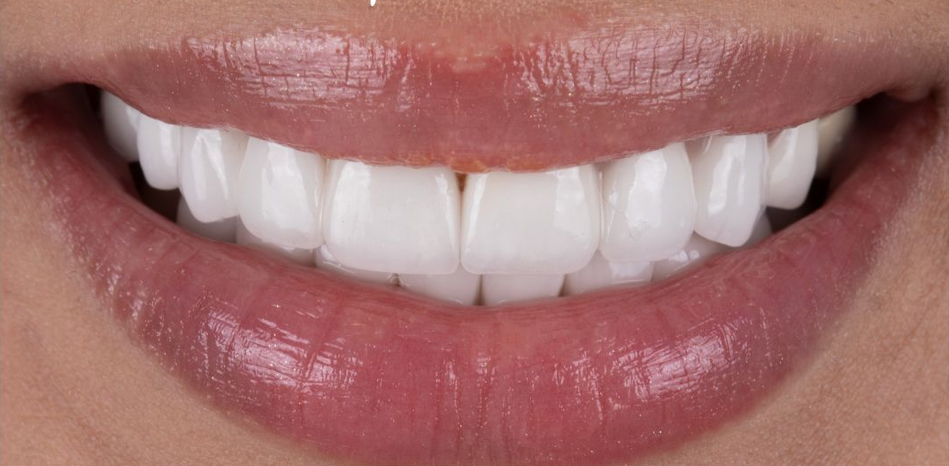 Smiles Braces